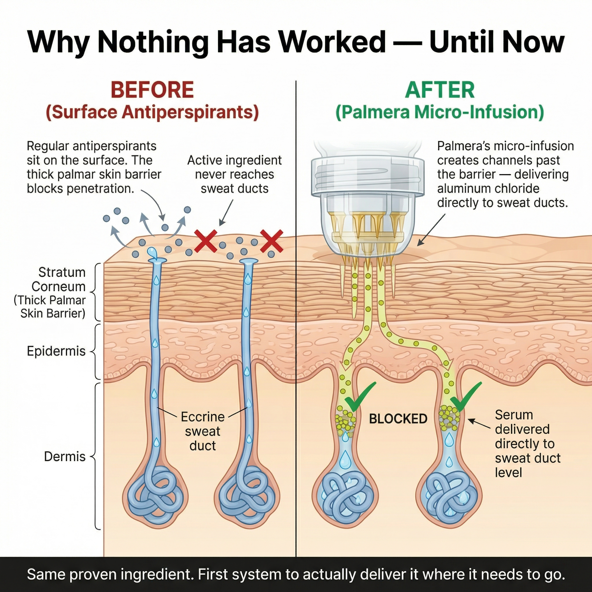 Palmera Hyperhidrosis Micro Infusion System